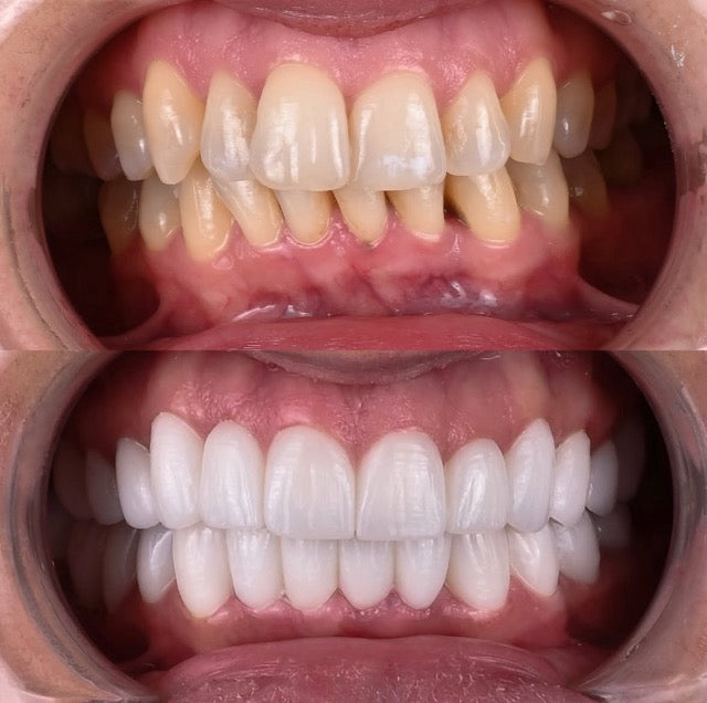 Da li je Hollywood Smile bolan tretman?