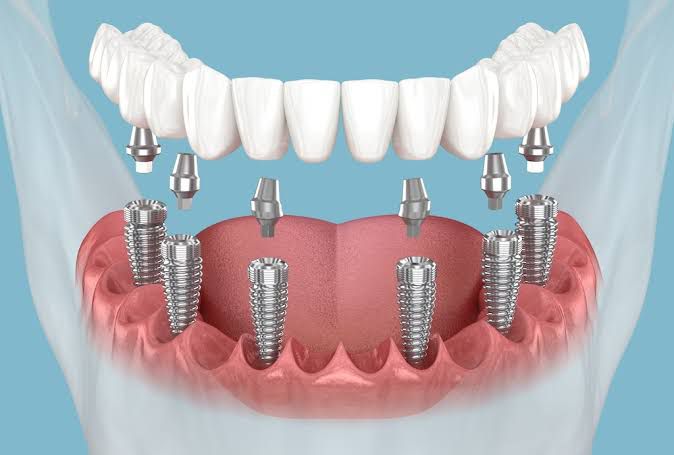 Razlika između All on 4 i All on 6 implantata